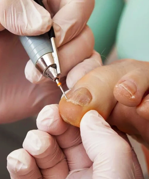 tırnak tedavisi batık tırnak düzeltme ve nasır bakımı