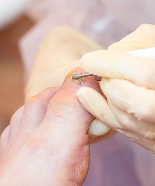 tırnak tedavisi batık tırnak düzeltme ve nasır bakımı